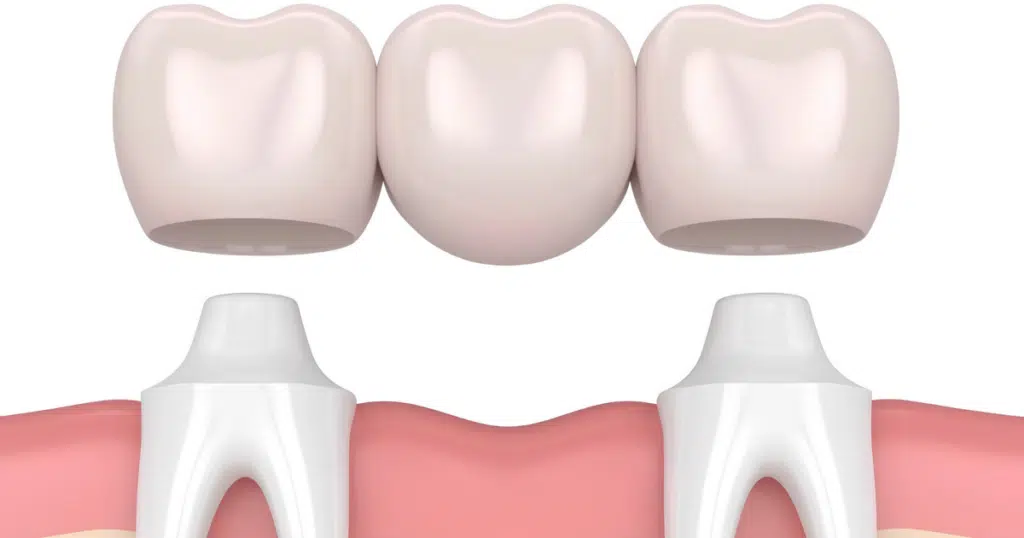 Dental Bridges - Siebenthaler Dental - featured image