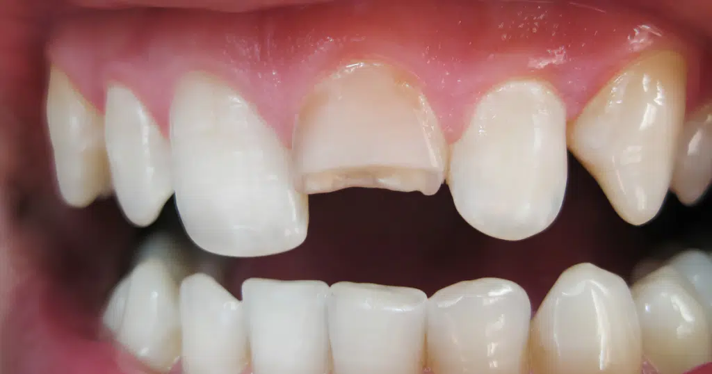 Trauma & Injuries - Siebenthaler Dental - featured image